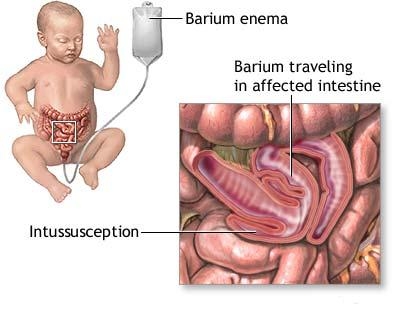 poza despre ocluziile intestinale